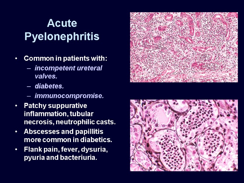 Acute Pyelonephritis Common in patients with: incompetent ureteral valves. diabetes. immunocompromise. Patchy suppurative inflammation,